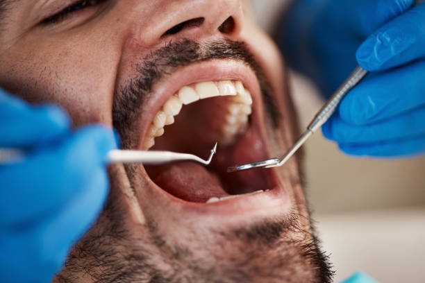 Best Knocked-Out Tooth (Avulsed Tooth) Treatment in Kent, WA